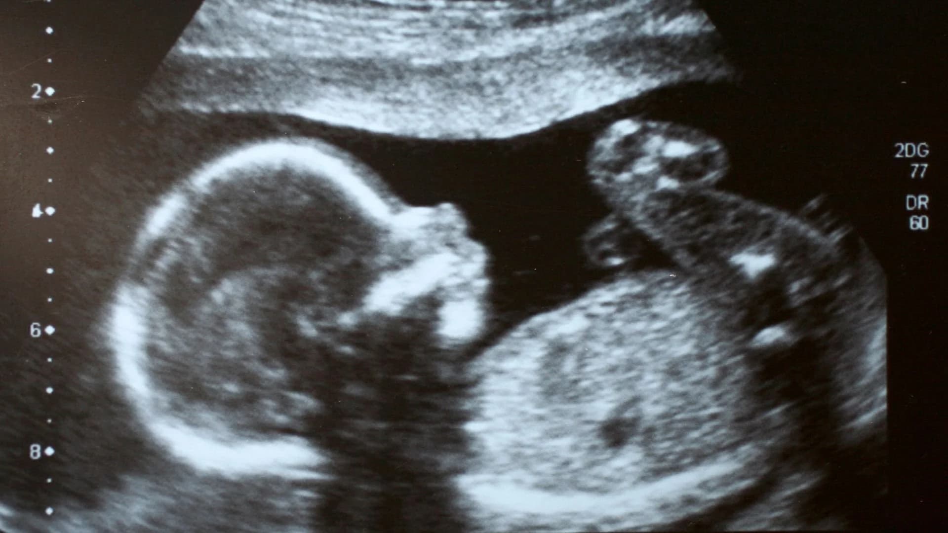Ultrasound Kehamilan