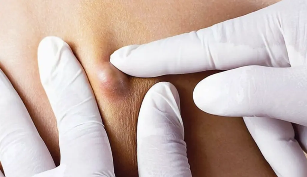 Pembuangan Lipoma